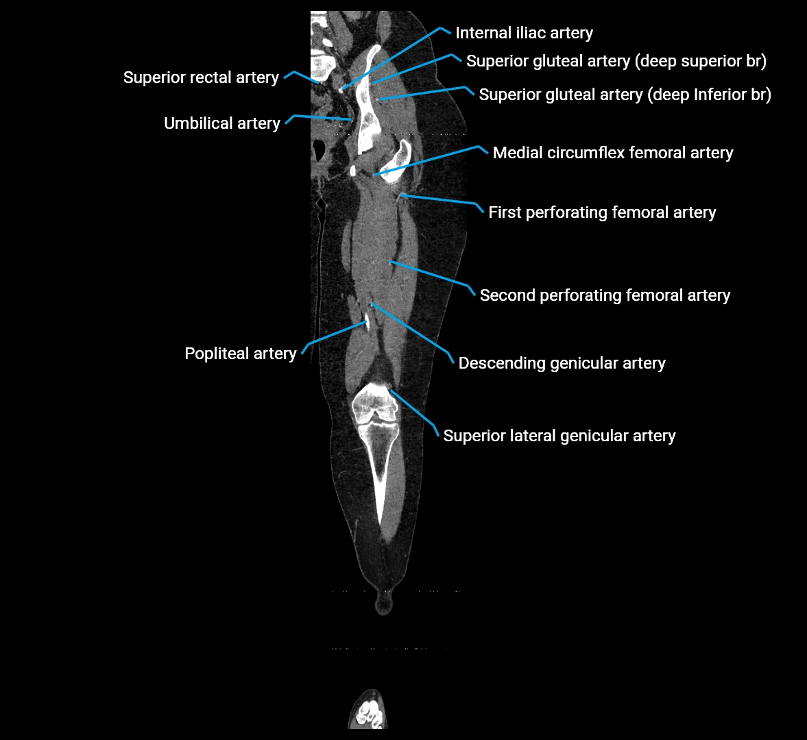 CTA lower limb coronal cross sectional anatomy labelled image _46 (2).webp